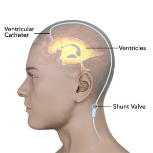 VP Shunt Surgery - Image 2