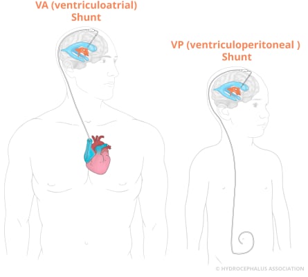 VP Shunt Surgery - Image 3