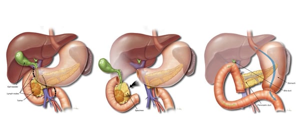 Whipple Surgery - Image 3